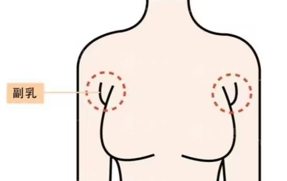 副乳是否必须要切掉去除？